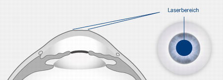 Лазерная коррекция зрения - Femto-LASIK совершенствование классического LASIK