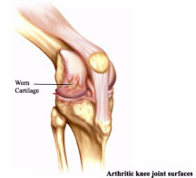 Остеоартроза коленного сустава - Arthritic Knee