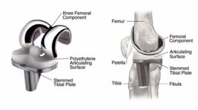 Эндопротезирования коленного сустава в Израиле - протезы коленных суставов