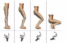 Замена коленного сустава - протезы нового поколения