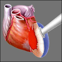   -   Heart Laser,     ,      