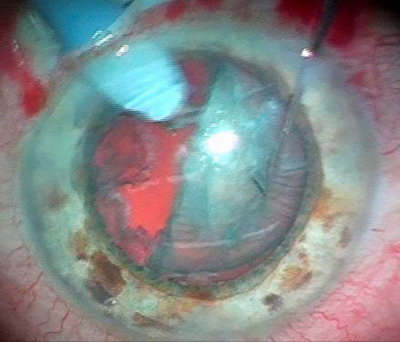 Операции факоэмульсификации катаракты с имплантацией псевдоаккомодирующих мультифокальных хрусталиков Acrysof Restor