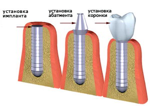 Этапы классической имплантации зубов