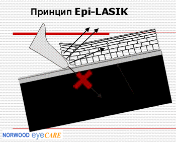 Epi-LASIK